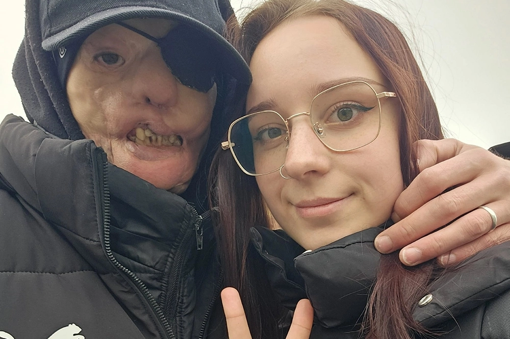 
        Любовь спасла. Игорь Виноградов, чье лицо обглодал стафф, женился    