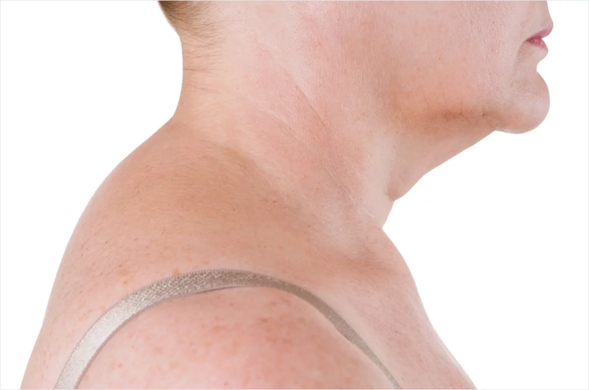 
        Горбик зарядка исправит. Комплекс упражнений против холки    