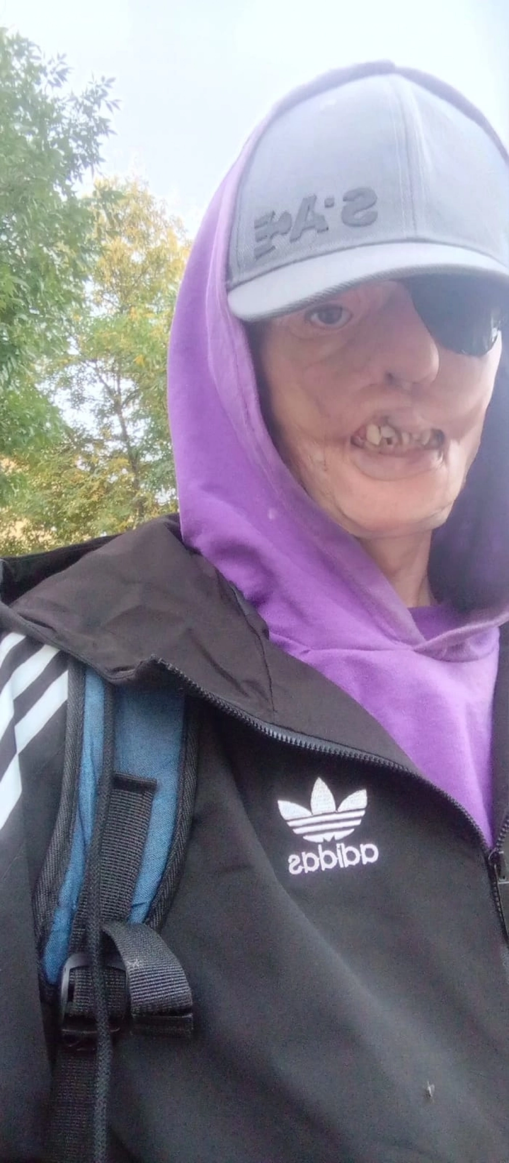 
        &laquo;Кровь и слезы&raquo;. Как живет парень, чье лицо 20 лет назад обглодал стафф    