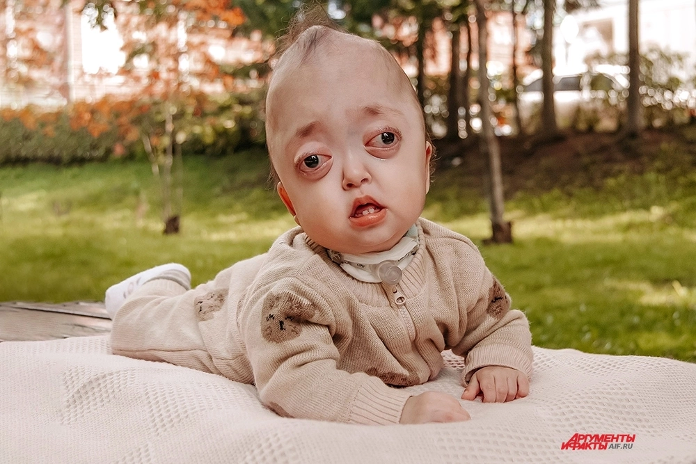 Пульсация мысли. Малышка Айпери нуждается в операции по реконструкции черепа
Пульсация мысли. Малышка Айпери нуждается в операции по реконструкции черепа